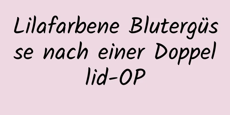 Lilafarbene Blutergüsse nach einer Doppellid-OP